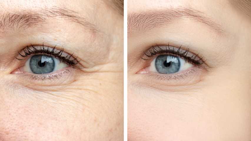 Woman face, eye wrinkles before and after treatment – the result of rejuvenating cosmetological procedures of biorevitalization, botox and pigment spots removal