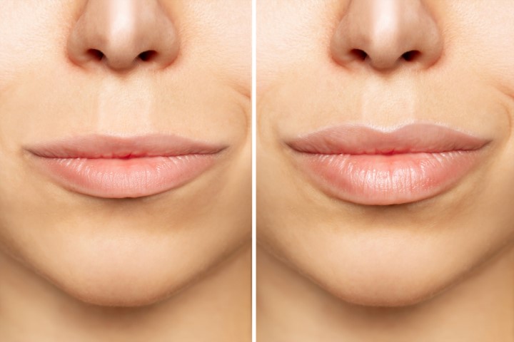 Two shots of young woman’s lips before and after lip enhancement. Lip augmentation